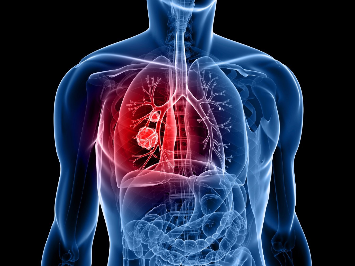 Bệnh ung thư phổi - Những điều cần biết